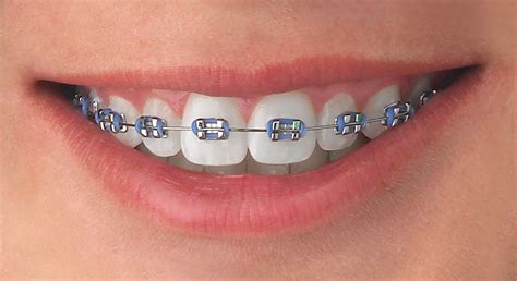 colores de brackets modernos